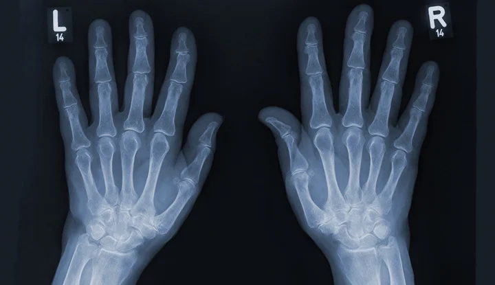 photon bilateral hand x-ray