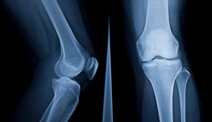 photon knee x-ray