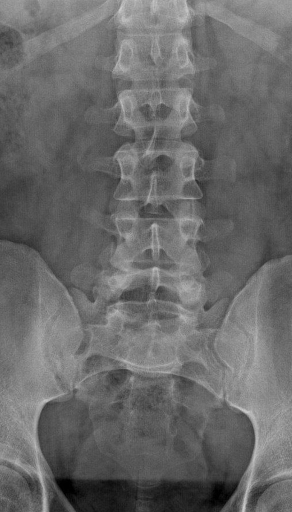 photon l-spine x-ray